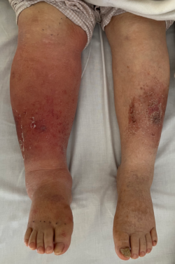 左：筆者の右下腿（立位）．立位になると表在血管の拡張がよくわかる．