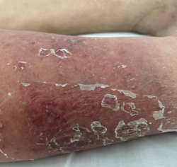 右：筆者の右足（臥位）．内果を中心に毛細血管が集簇している．