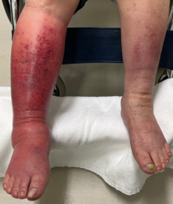 両下腿の初赤と腫脹（再発時）