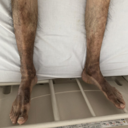 図9-1-1 両下肢の皮疹と色素沈着