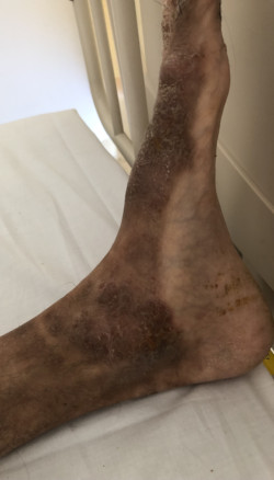 図9-1-2 両下肢の皮疹と色素沈着左下腿の皮疹と色素沈着