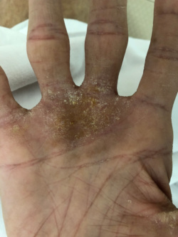 図9-1-3 右手の皮疹