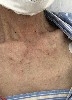 図9-1-4 前胸部の皮疹