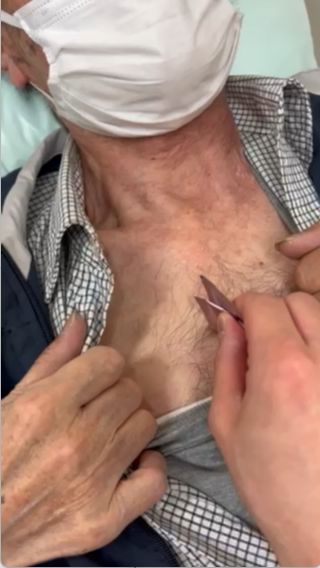 中心静脈カテーテル挿入（CVC）1/2